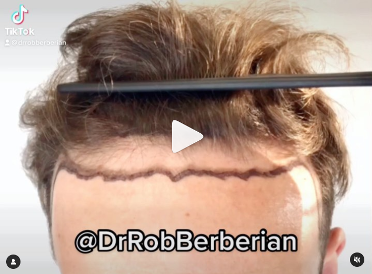 Dr. Rob Berberian - VIP FUE Hair Transplant - Newport Beach