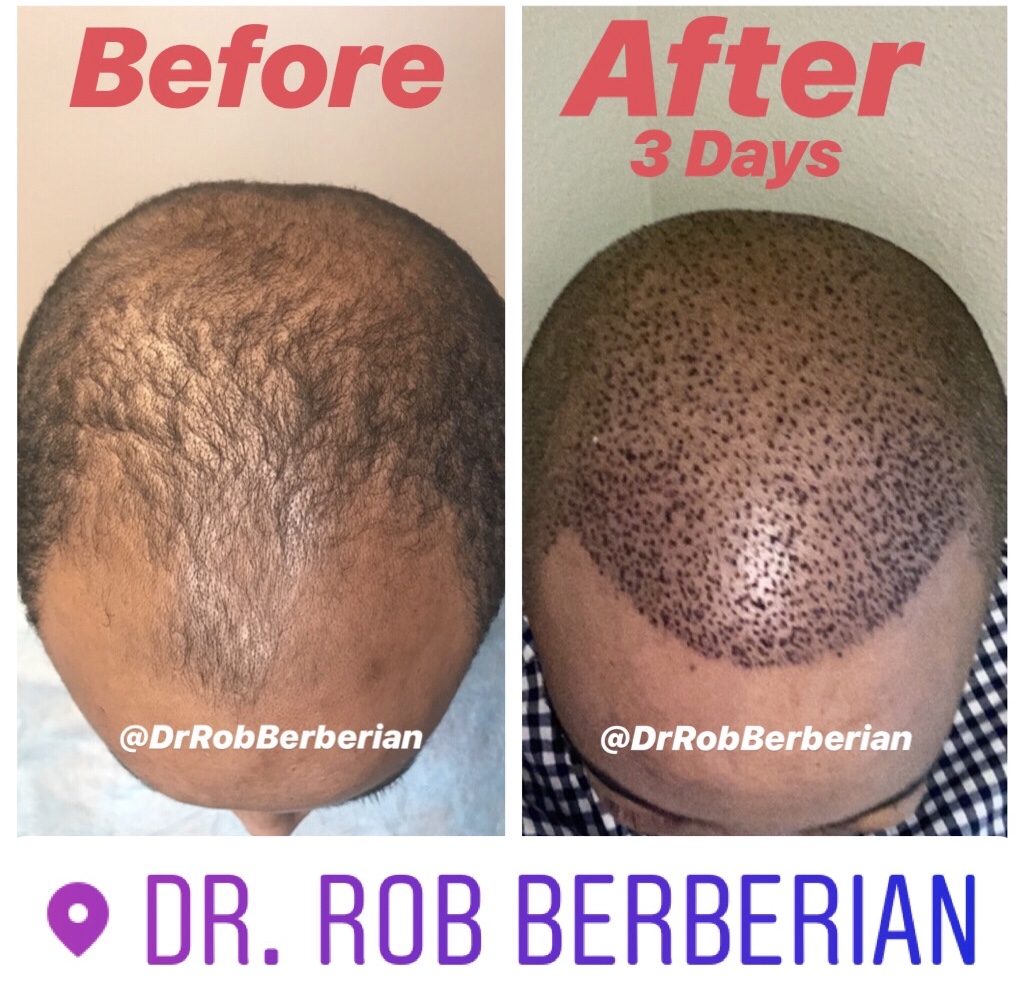 Dr. Rob Berberian FUE Hair Transplant African American