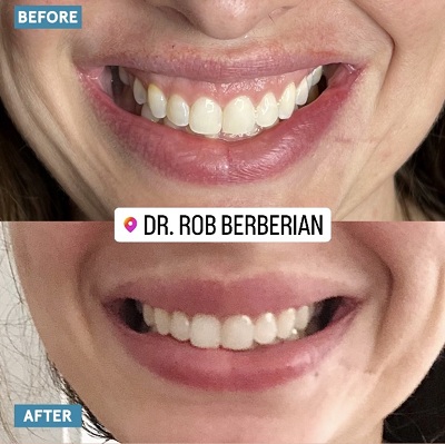 Dr. Rob Berberian - Gummy Smile Treatment