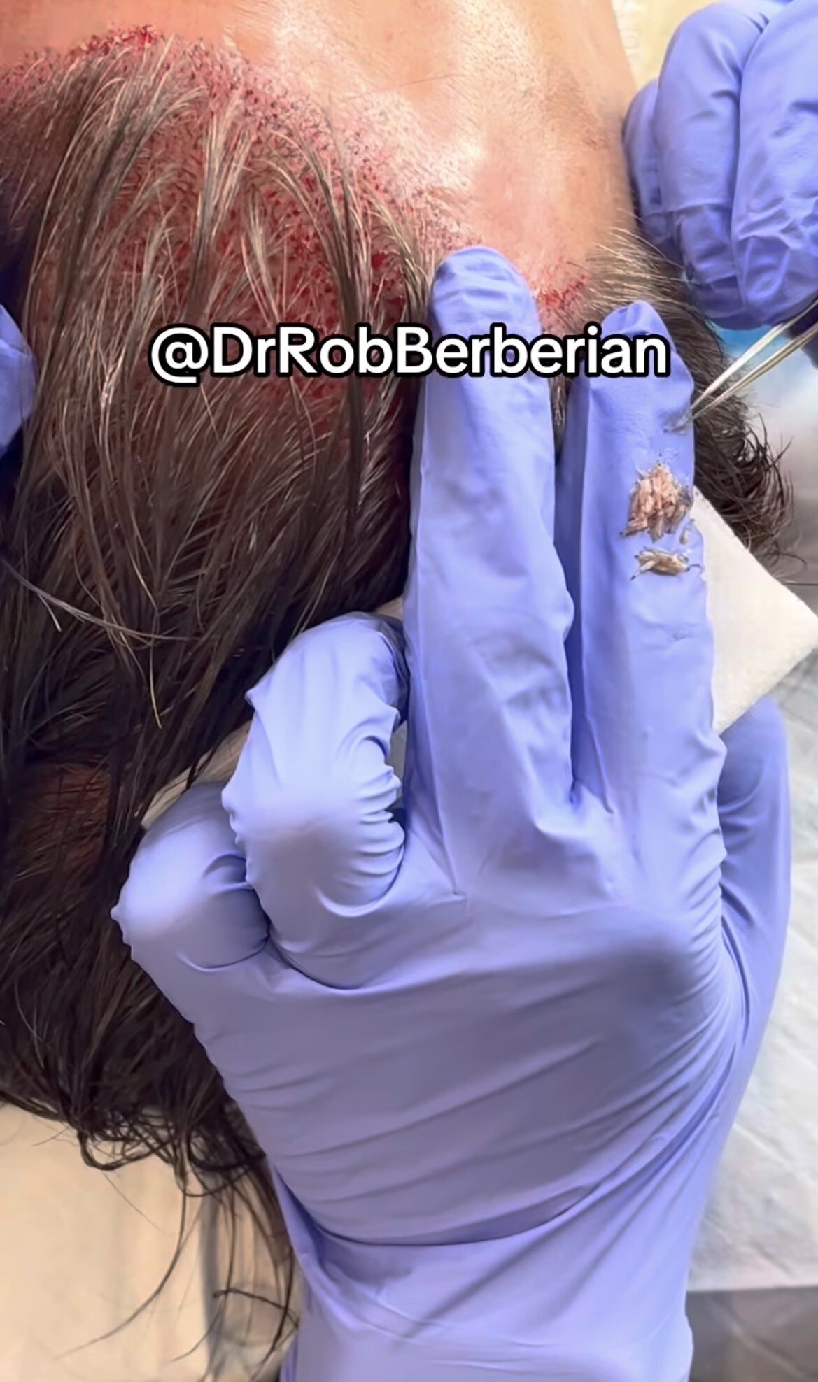 Dr. Rob Berberian VIP FUE Hair Transplant Newport Beach & Los Angeles California 