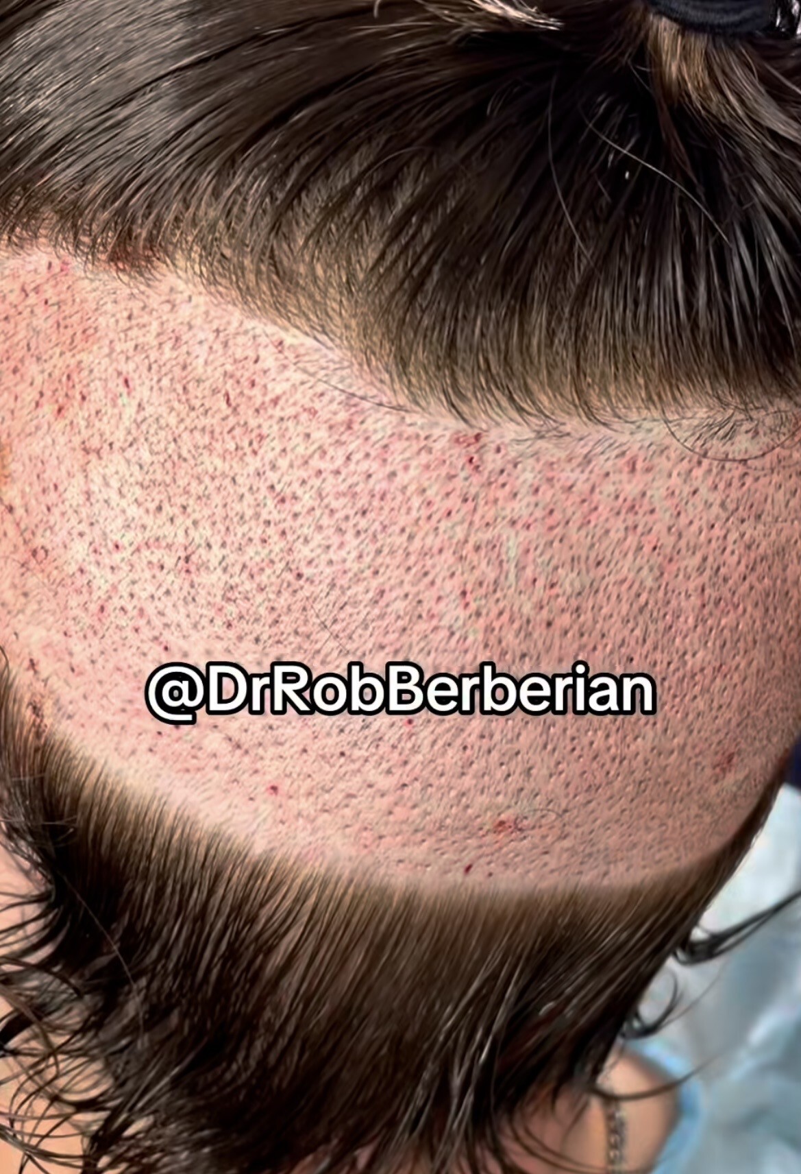 Dr. Rob Berberian VIP FUE Hair Transplant Newport Beach & Los Angeles California 