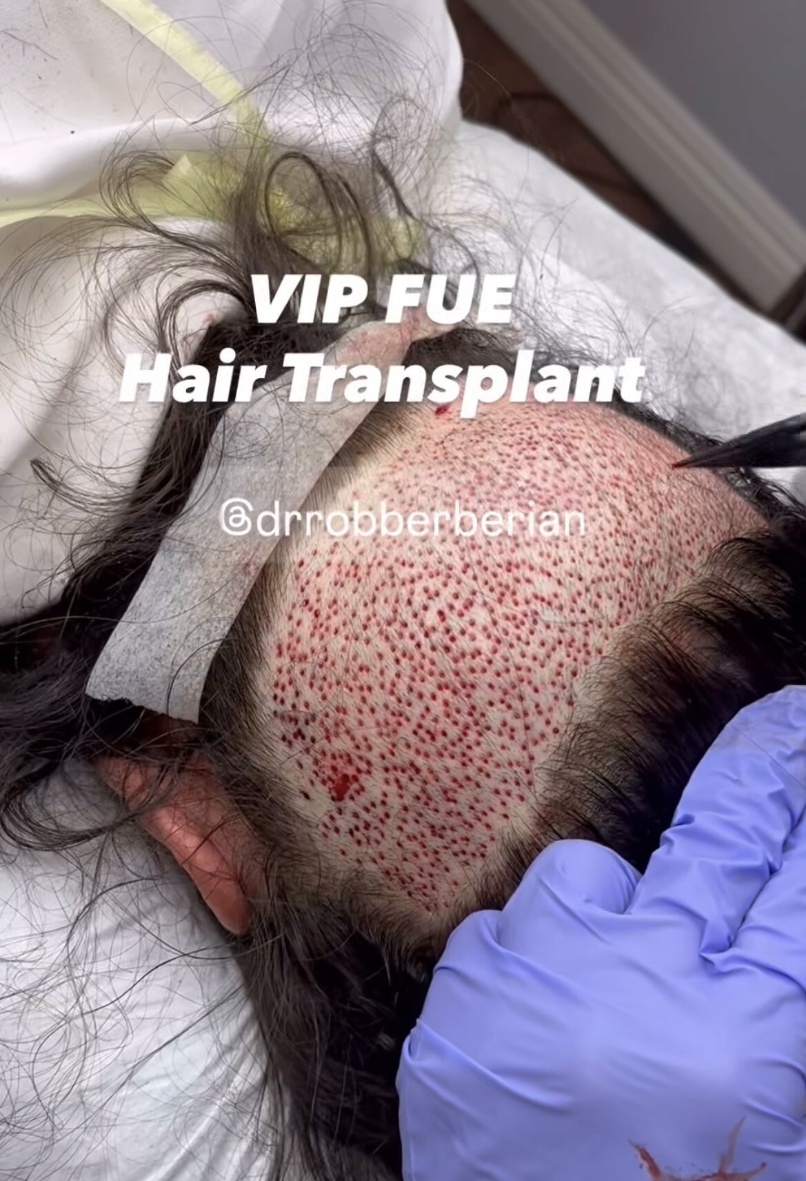 Dr. Rob Berberian VIP FUE Hair Transplant Newport Beach & Los Angeles California 