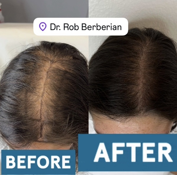 Female Hair Transplant Dr. Rob Berberian Before After Los Angeles & Newport Beach California